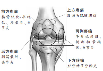 膝盖痛可能是啥问题?