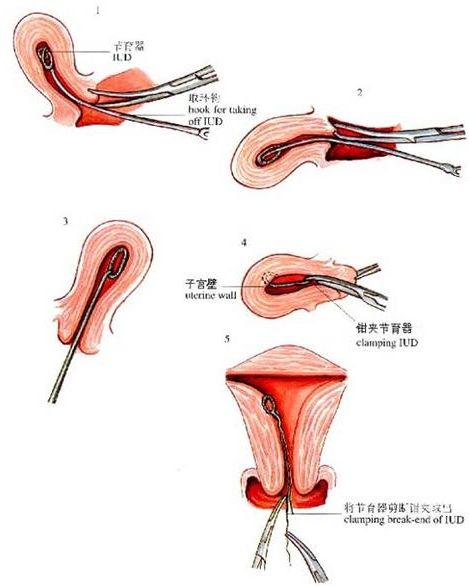 最简单的术_自己可以做的和合术 和合术最简单的方法