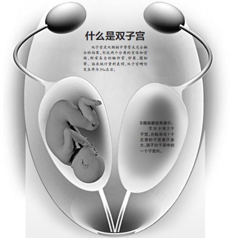 怀孕6个月的准妈妈有两个子宫 羊水破了后才发现