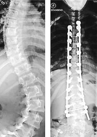 11岁女孩患特发性脊柱侧弯 两肩高差10厘米脊柱弯成s型