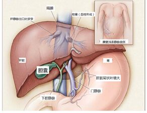 婴儿患婴肝综合症成金娃娃 婴肝综合症怎样治