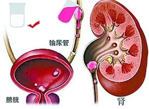 什么是肾积水?龙凤胎长了5个肾患有重度肾积水