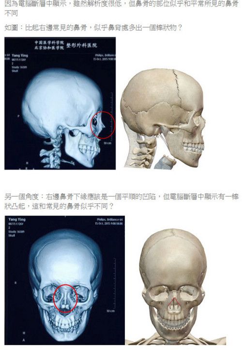 台整形医师质疑baby面部鉴定结果:鼻骨有棒状物-人民网娱乐频道