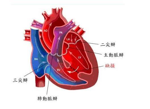 去县医院做彩超,结果显示孩子是先心病,完全性大动脉赘=ㄆ档 万象