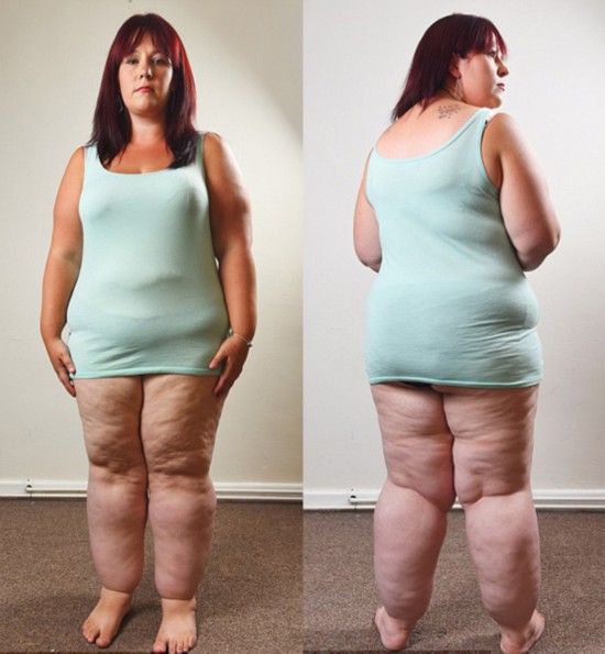 被误诊肥胖英女子实患脂肪综合症 腿粗如大象
