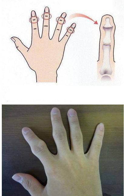 原因二:手指关节"太凸.