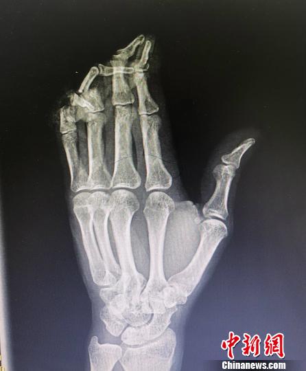 图为许师傅受伤手部的x光片. 院方提供 摄