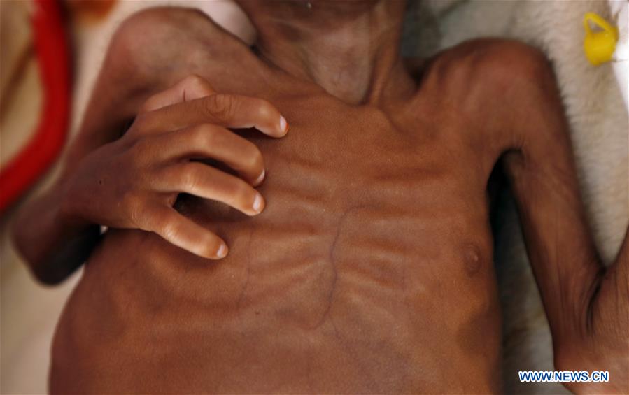 YEMEN-SANAA-CHILDREN-MALNUTRITION